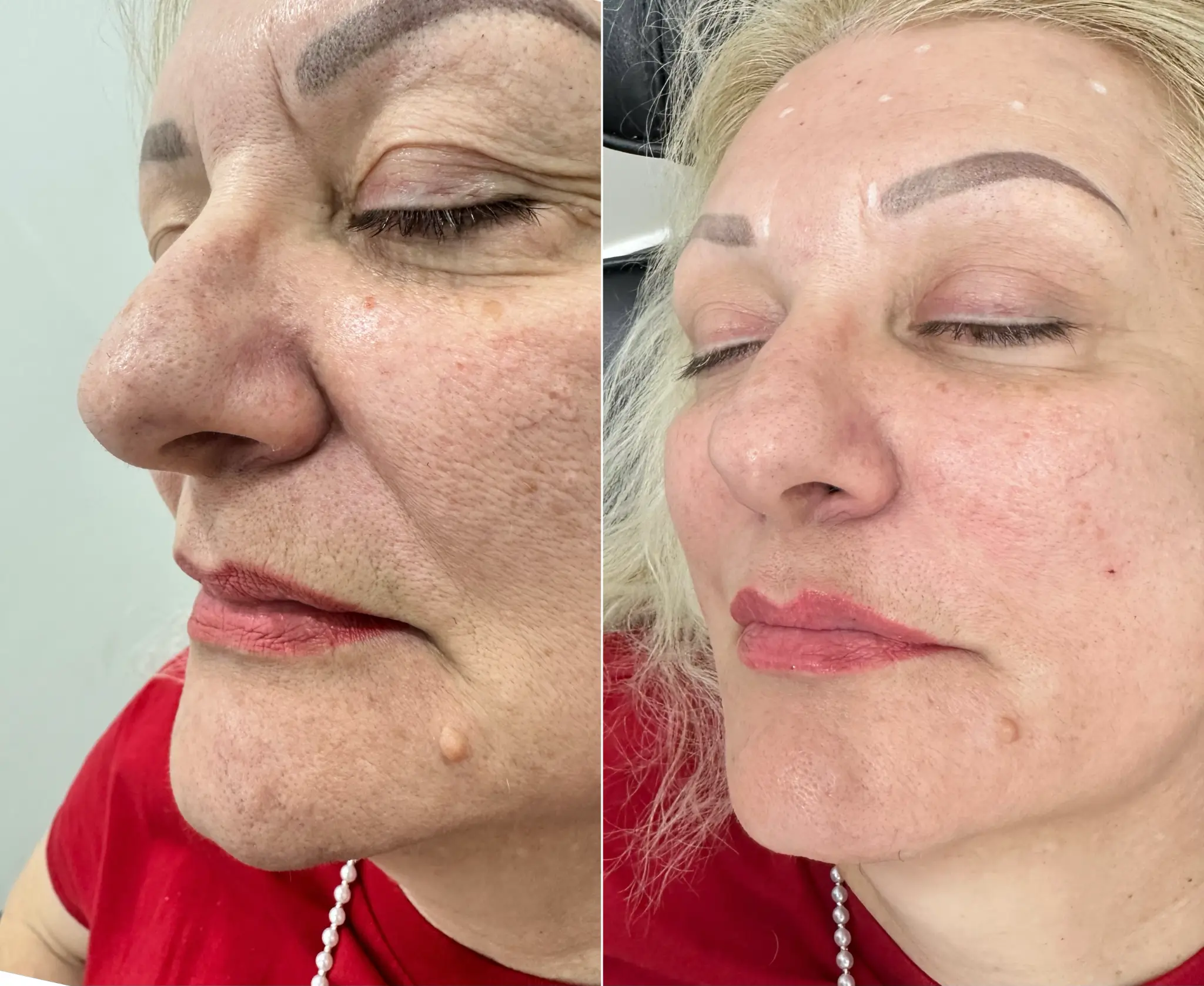Botox before and after results
