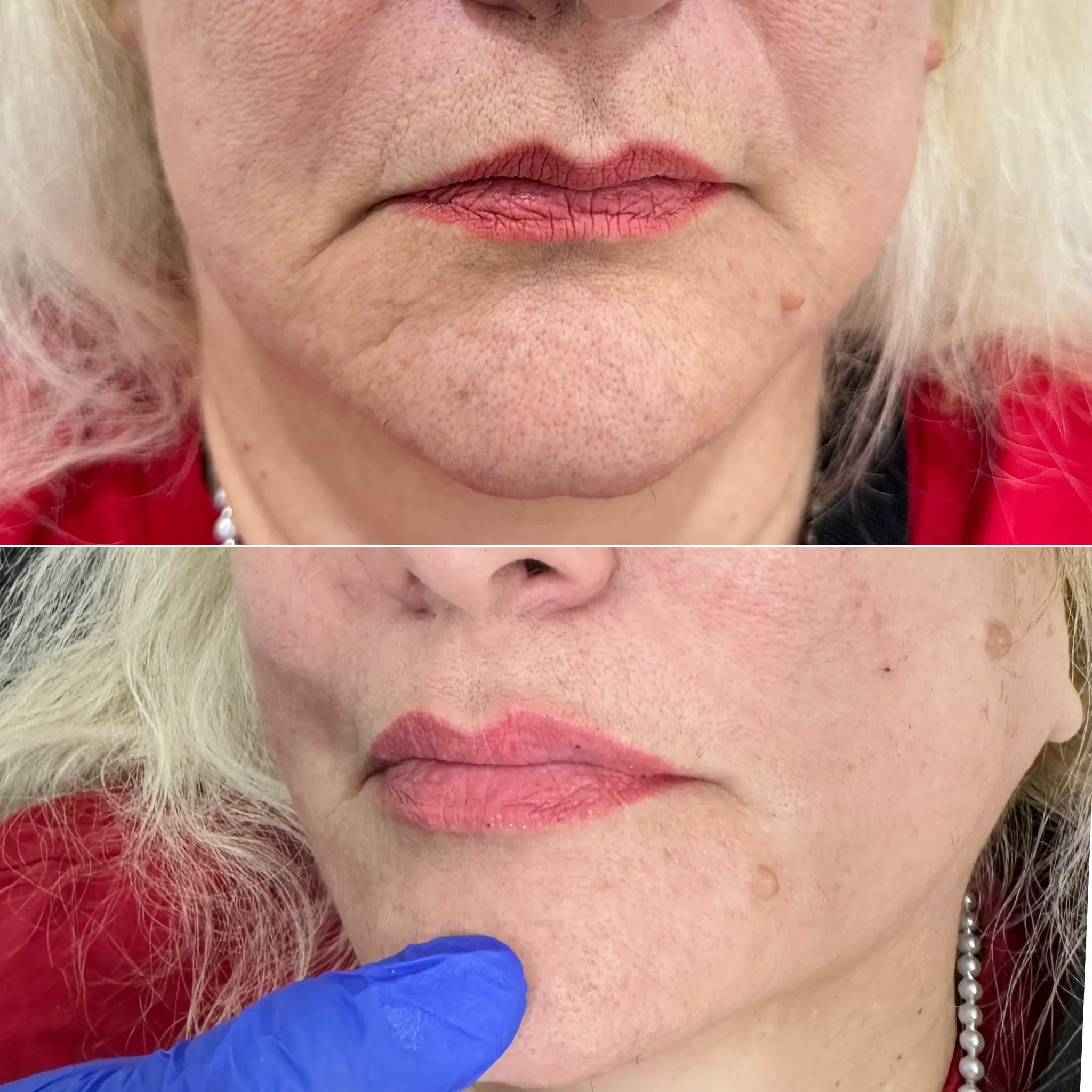Lip filler before and after results