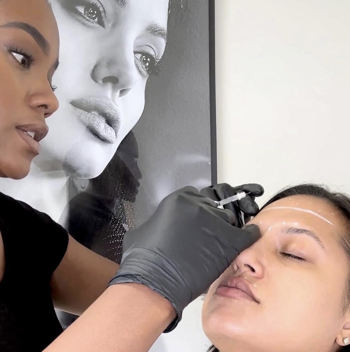 Precision forehead injection technique