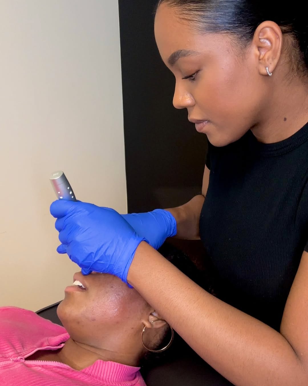 Microneedling Treatment